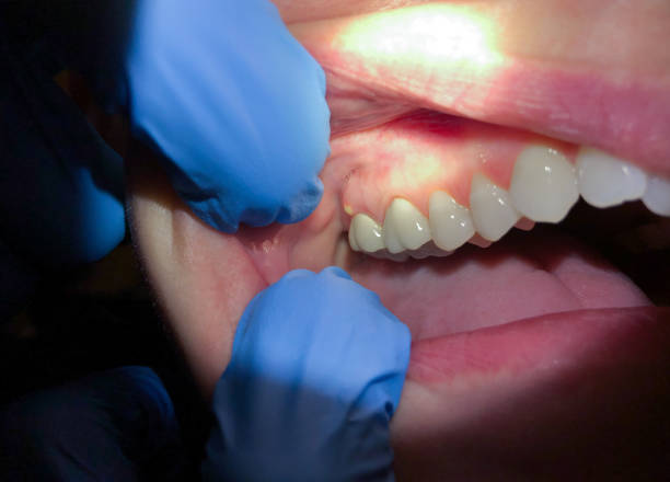 Best Emergency Dental Extractions in Tawas City, MI